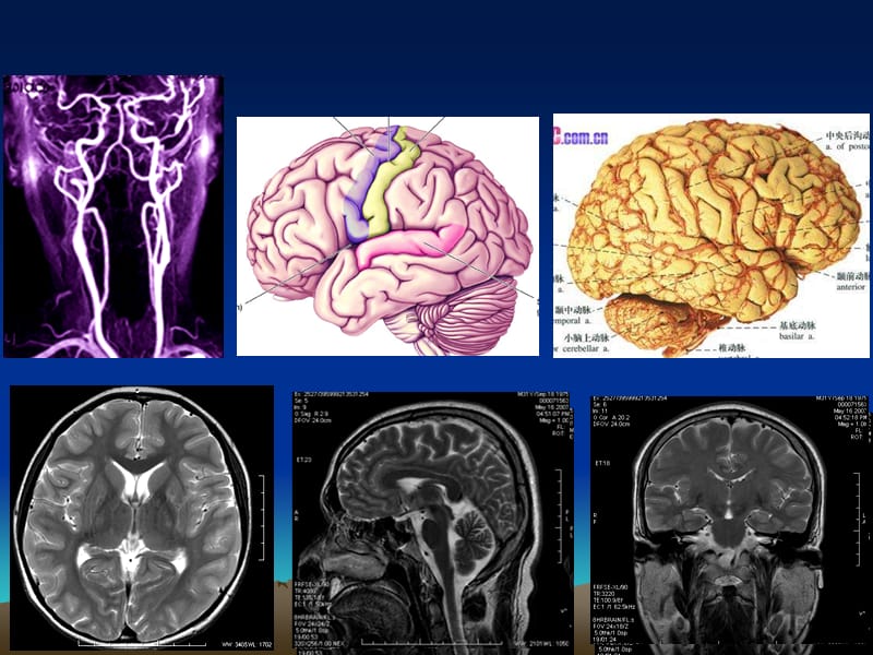 脑血管断层影像解剖PPT课件.ppt_第2页