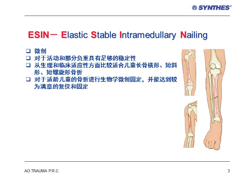 2019年《弹力钉的应用》ppt课件.ppt_第3页