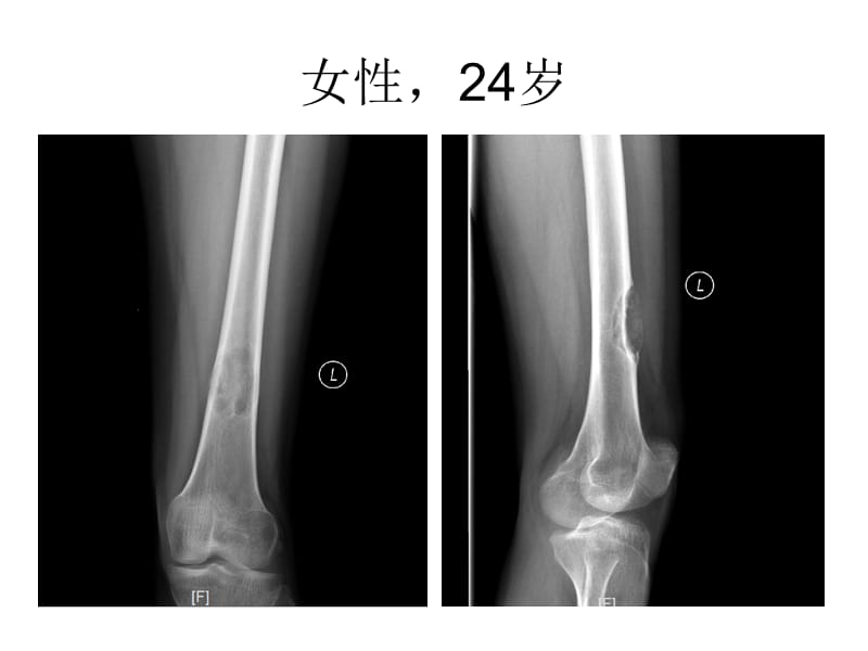 2019年软骨粘液样纤维瘤的x线诊断及鉴别诊断ppt课件.ppt_第3页