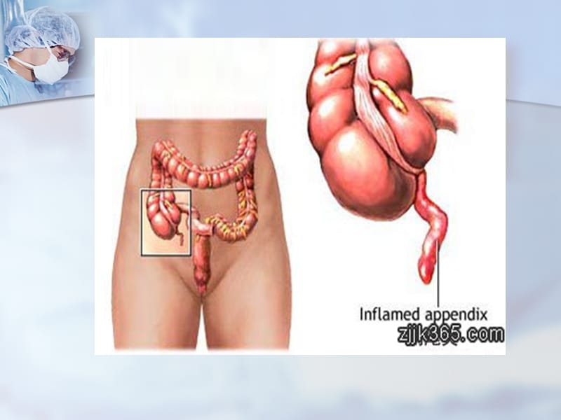 普外科护理业务查房--急性阑尾炎PPT课件.ppt_第3页