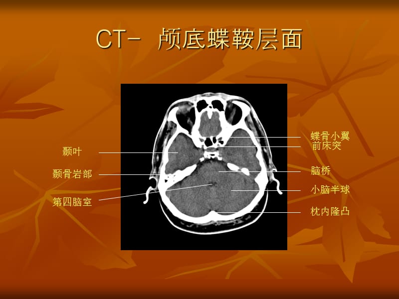 颅脑断层解剖PPT课件.ppt_第2页