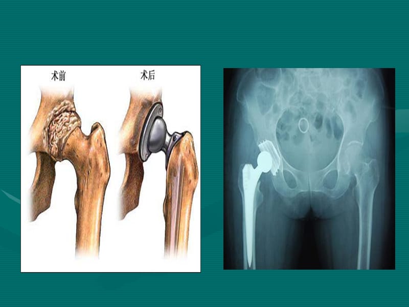 2019_髋关节置换术围手术期的护理.ppt_第3页