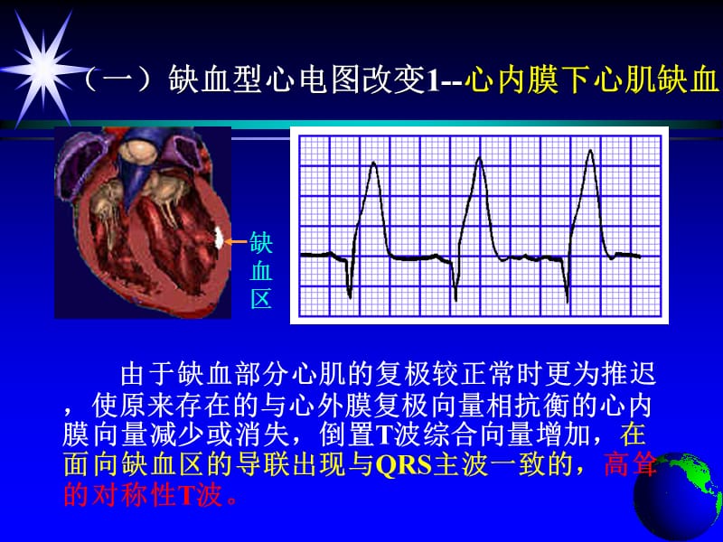 20195心肌缺血、心肌梗死.ppt_第3页