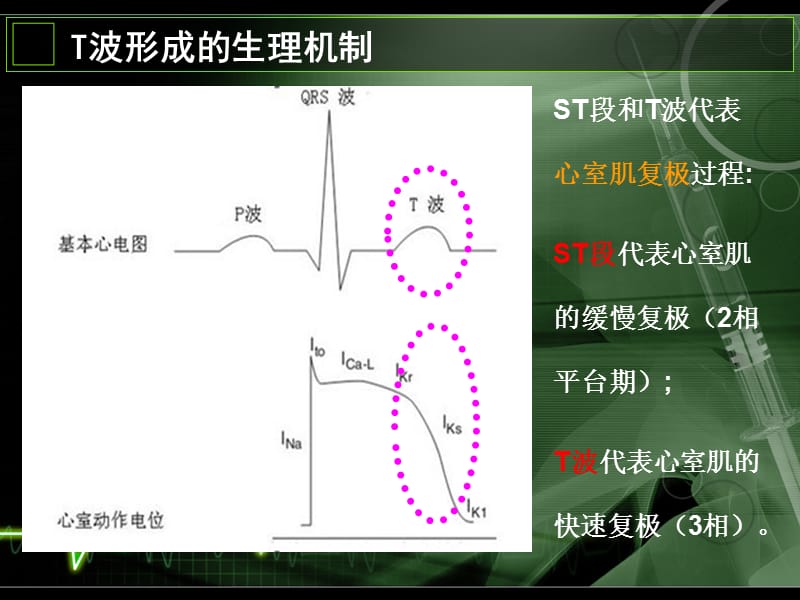 2019T波倒置的认识与诊断(年金华心血管年会).ppt_第2页