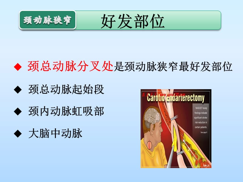 颈动脉狭窄的治疗与护理-第四军医大学唐都医院神经外科王学廉.ppt_第3页