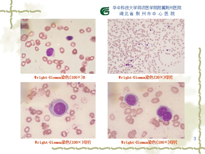 骨髓穿刺干抽病例的骨髓活检印片和切片读片.ppt_第3页