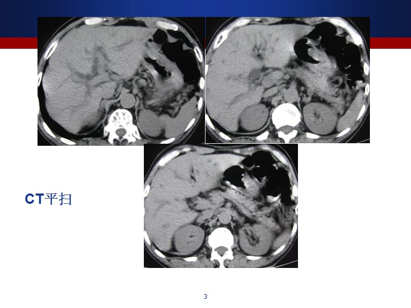 读片会病例讨论ppt课件.ppt_第3页