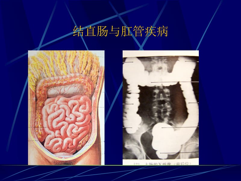 结直肠与肛管疾病ppt课件.ppt_第3页