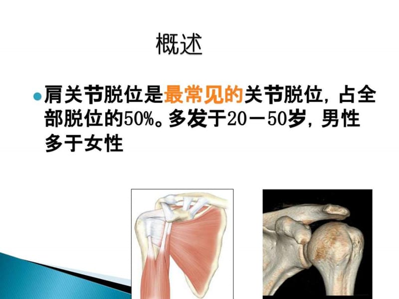 肩关节脱位最新进展研究.ppt_第2页