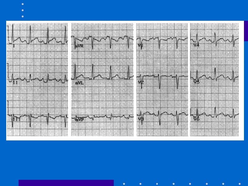 ECG心电图的解读.ppt_第2页