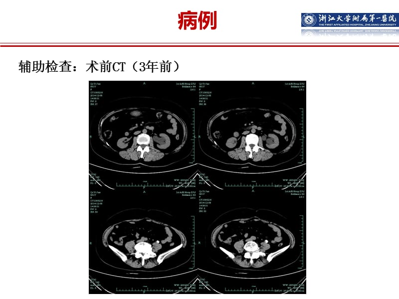 2017浙江省结石微创论坛嵌顿性结石病例分享ppt课件.ppt_第3页