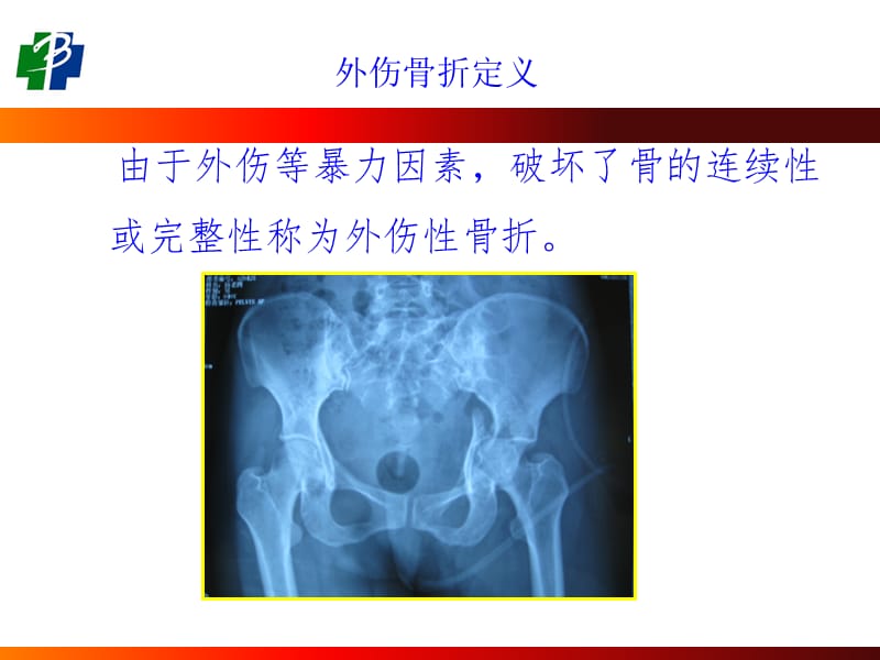 四肢骨折现场急救外固定技术ppt课件.ppt_第3页