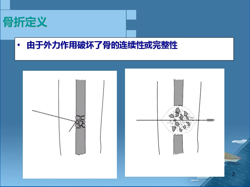 《b骨折概论》ppt课件.ppt_第2页