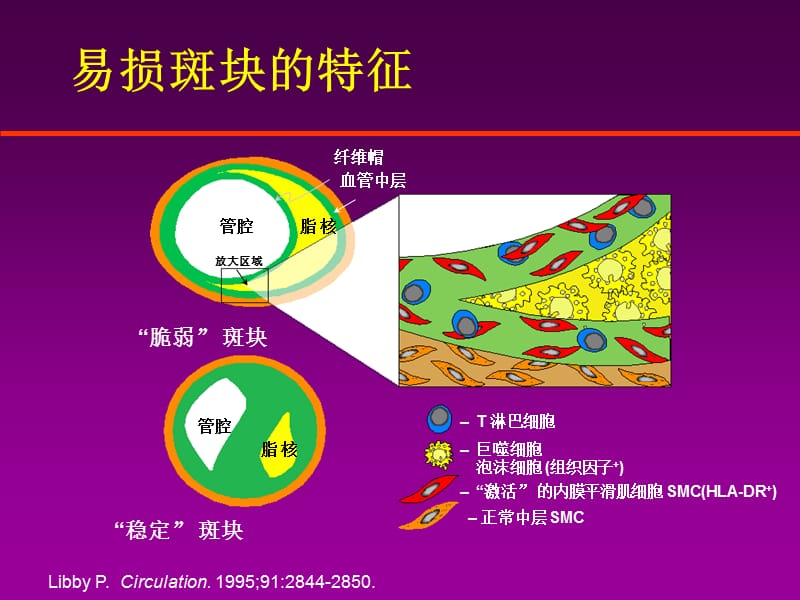 急性心肌梗死的治疗原则PPT课件.ppt_第3页