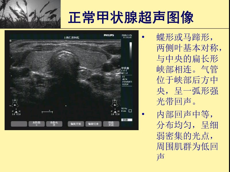 《甲状腺超声》ppt课件.ppt_第3页