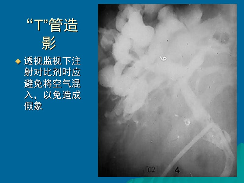 2019胆系影像诊断学.ppt_第3页