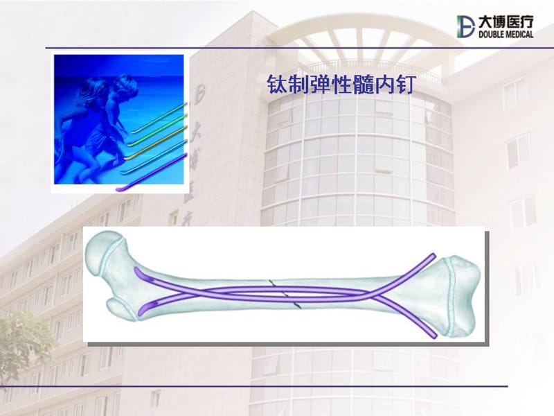 弹性髓内钉治疗儿童骨折操作技巧PPT.ppt_第1页