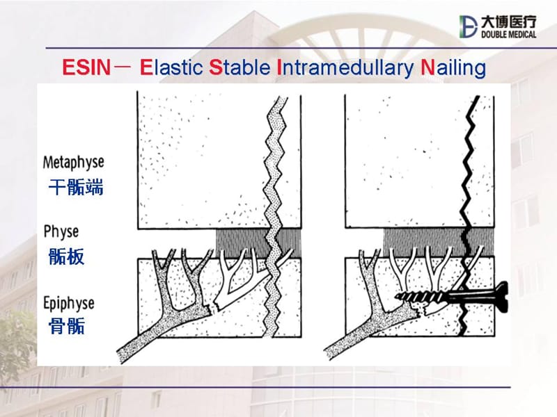 弹性髓内钉治疗儿童骨折操作技巧PPT.ppt_第3页