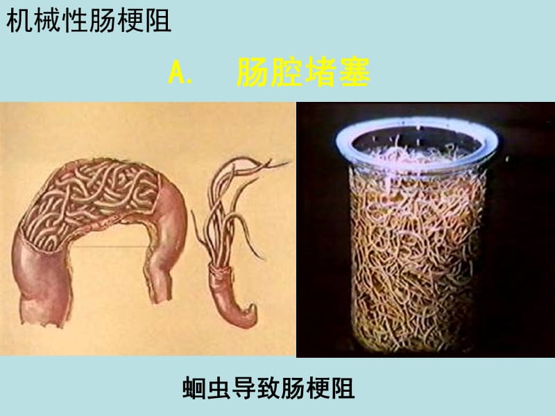 肠梗阻病理知识PPT课件.ppt_第3页