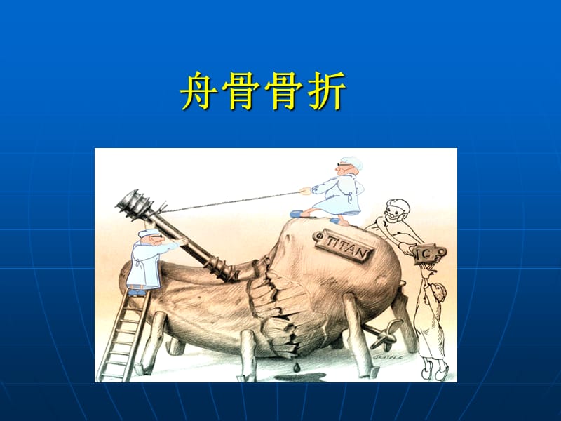 《舟骨骨折》ppt课件.ppt_第1页