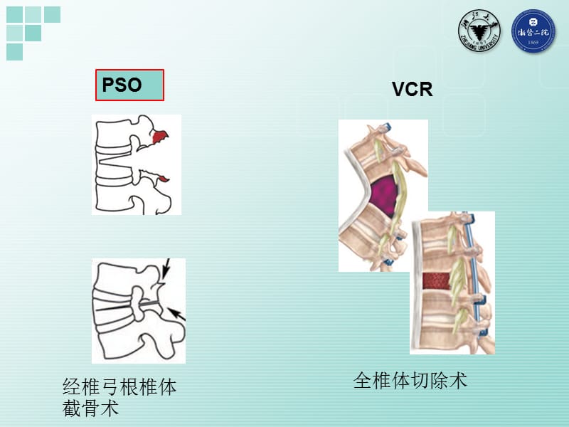 2019脊柱截骨矫形手术的安全保障 ppt课件.ppt_第3页