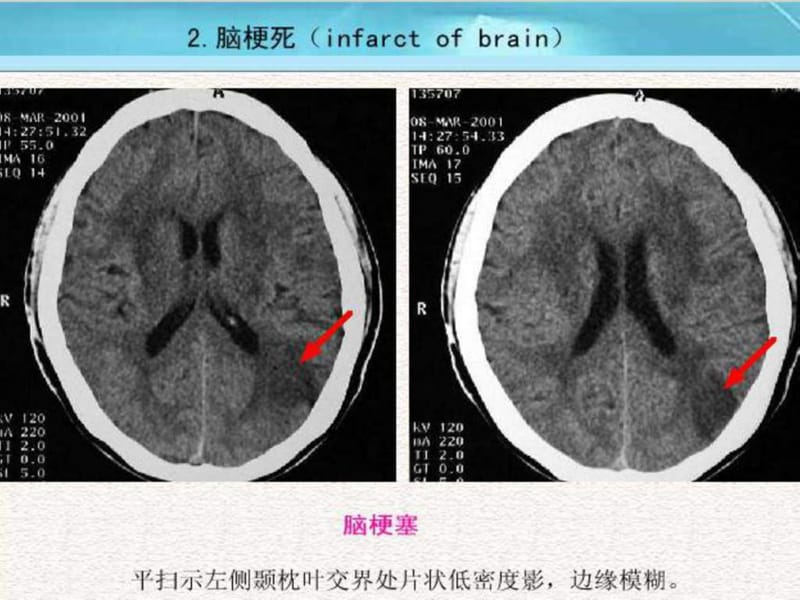 2019脑梗死与颅内出血出血CT影像.ppt.ppt_第3页