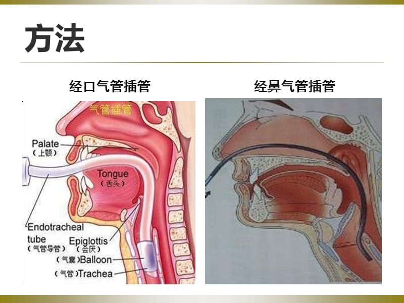 气管插管的护理PPT课件.ppt_第3页