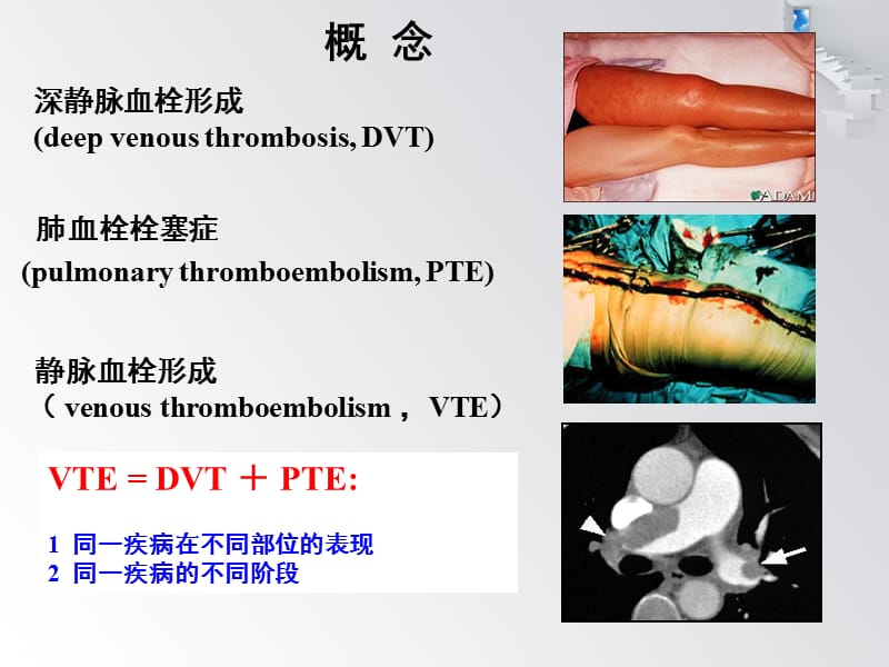 《肺血栓栓塞症》PPT课件.ppt_第2页