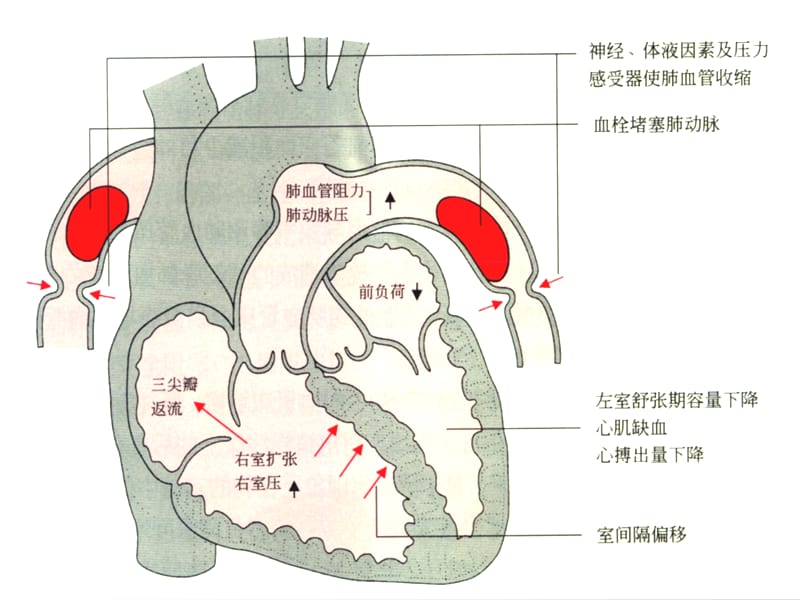 《肺血栓栓塞症》PPT课件.ppt_第3页