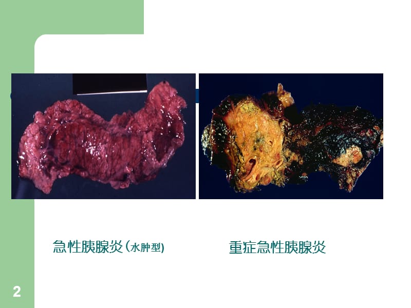 2019重症急性胰腺炎诊疗若干问题.ppt_第2页