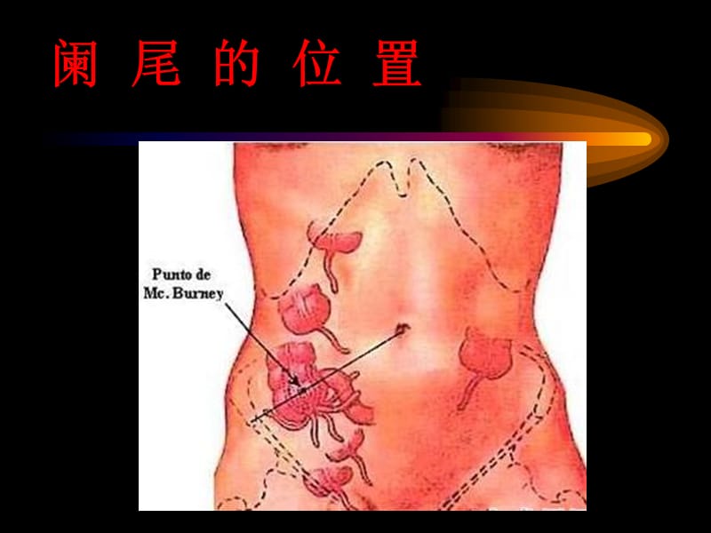 2019阑尾炎.ppt_第3页