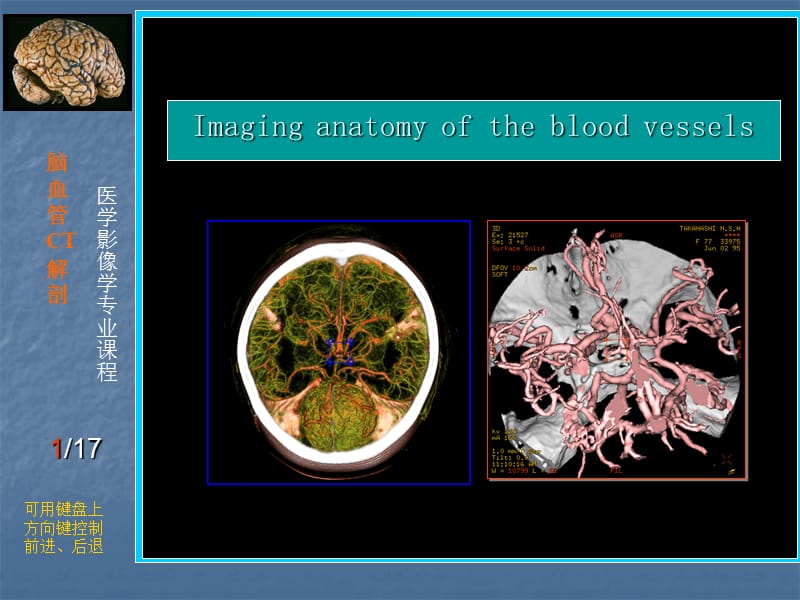 脑血管CT解剖PPT课件.ppt_第1页