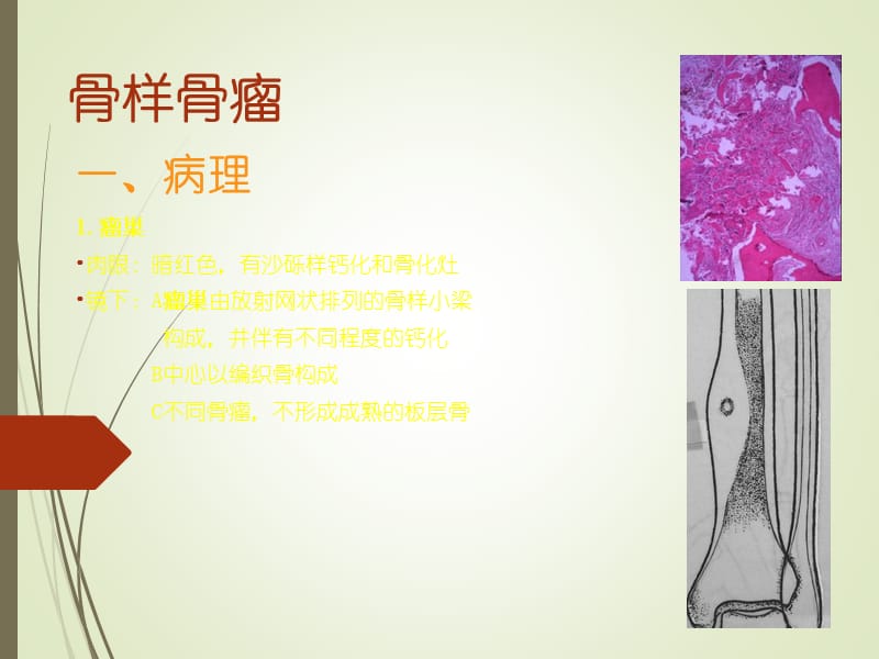 《良性骨肿瘤》ppt课件.ppt_第3页