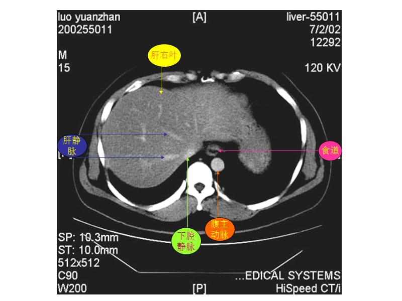 2019腹部CT资料2.ppt_第1页