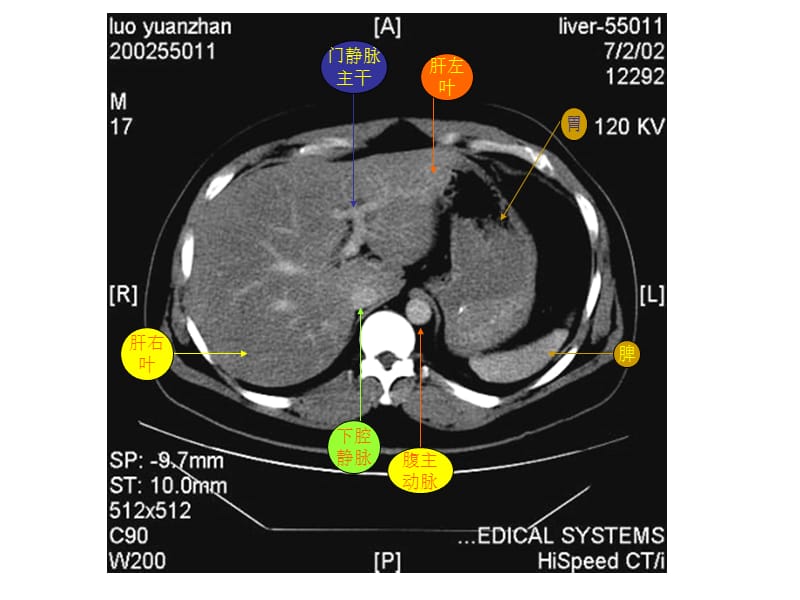 2019腹部CT资料2.ppt_第3页