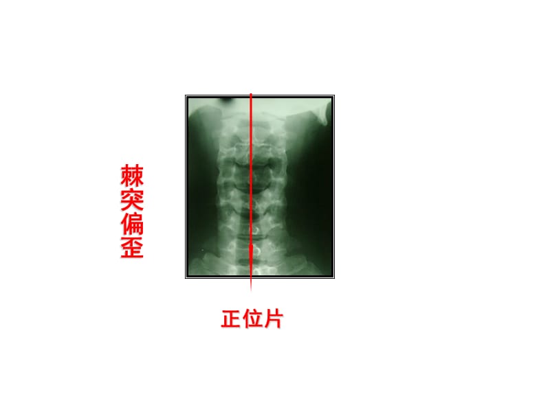 《颈椎病2011》ppt课件.ppt_第3页