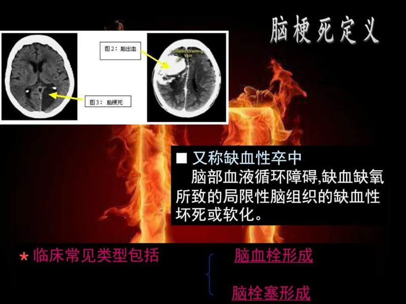 2019脑梗死PPT_图文_1509290596.ppt.ppt_第2页