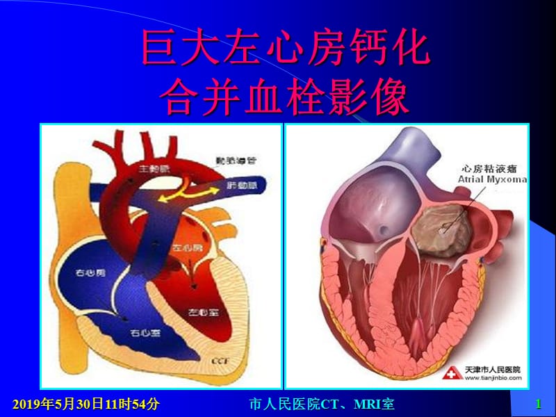 巨大左心房钙化合并没血栓影像ppt课件.ppt_第1页