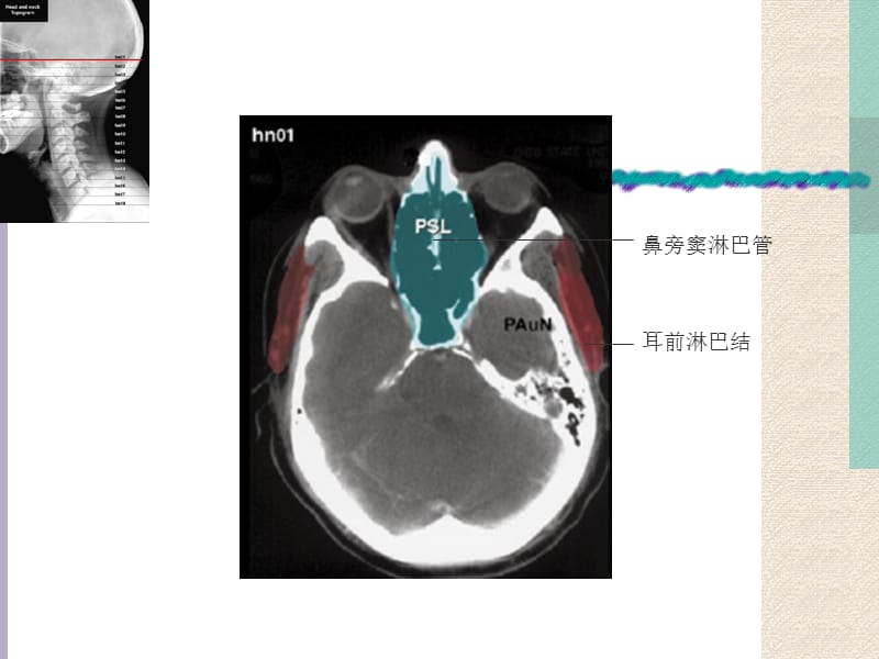 头颈部淋巴结断层图谱ppt课件.ppt_第2页