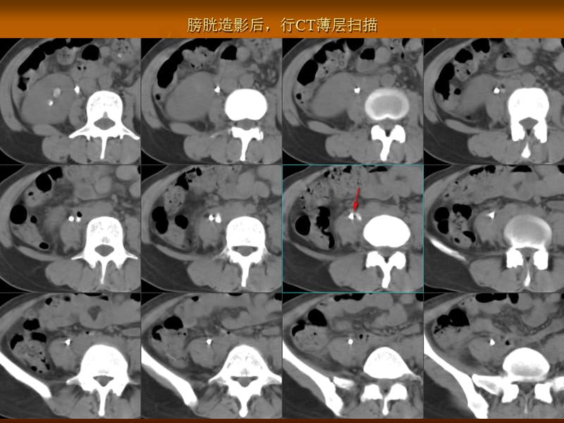 尿漏的影像检查方法及诊断ppt课件.ppt_第3页