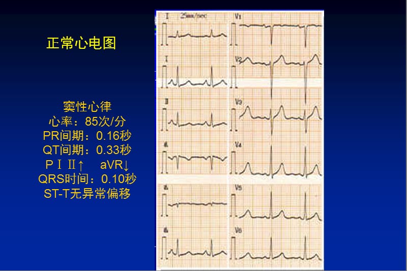 心律失常20呢12-11ppt课件.ppt_第2页