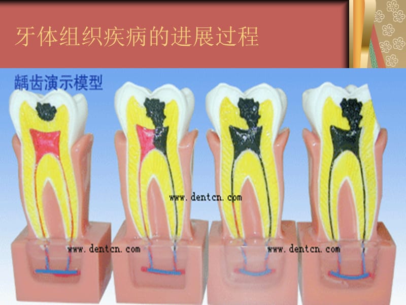 牙髓病和根尖周分病的病因ppt课件.ppt_第2页