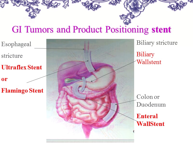 消化道支架的临都床应用.ppt_第2页