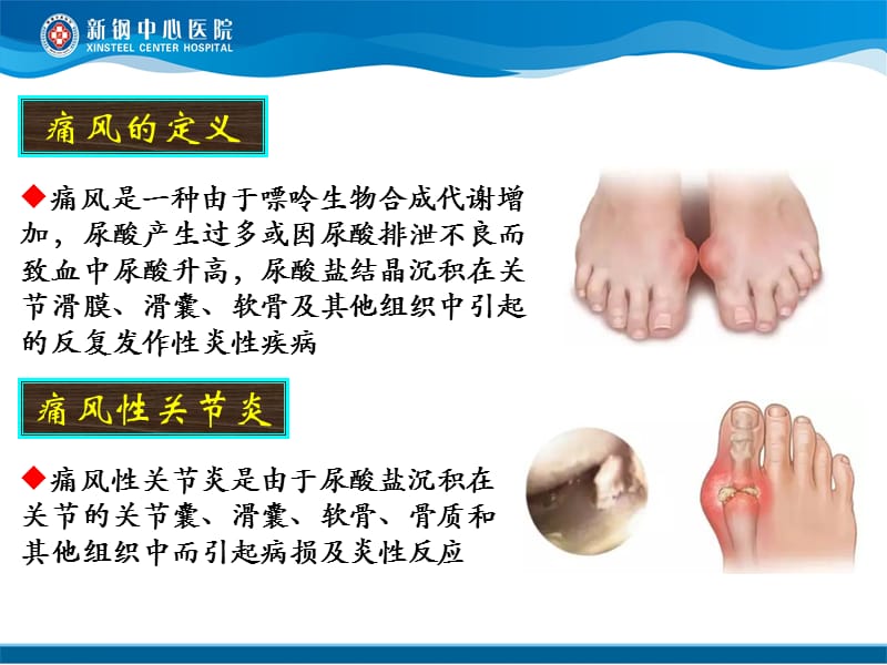 痛风性关节炎的中西医结合诊疗p没pt课件.ppt_第2页