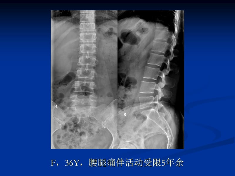 椎管内呢肿瘤病例随访ppt课件.ppt_第2页