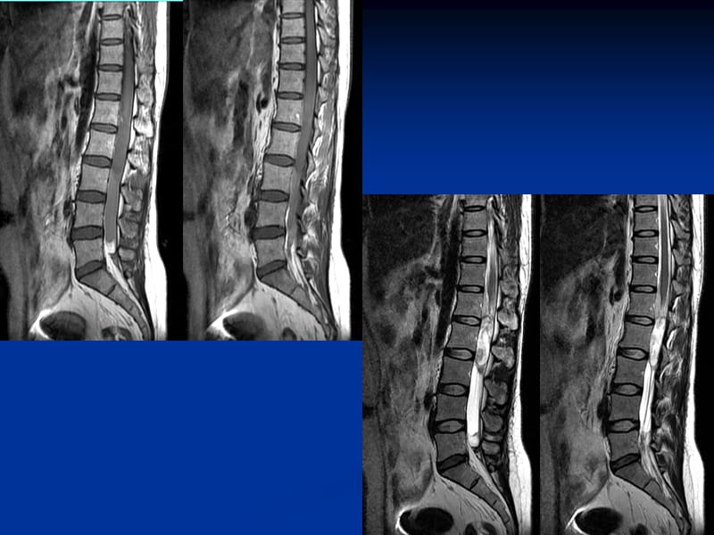 椎管内呢肿瘤病例随访ppt课件.ppt_第3页