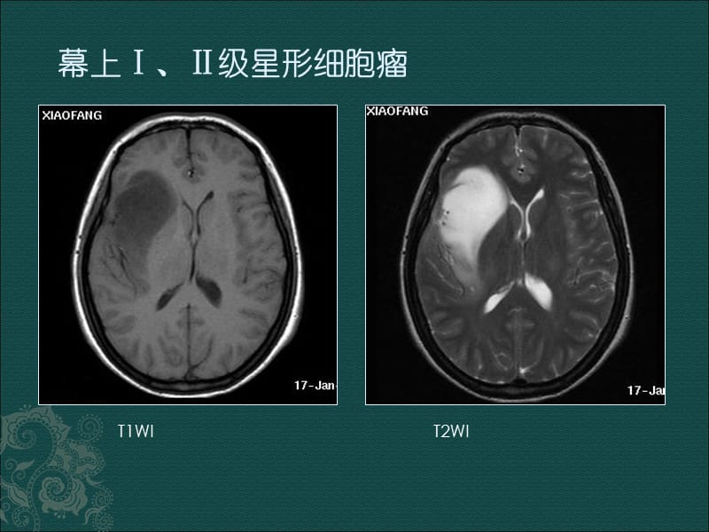 磁共振成但像读片题.ppt_第1页