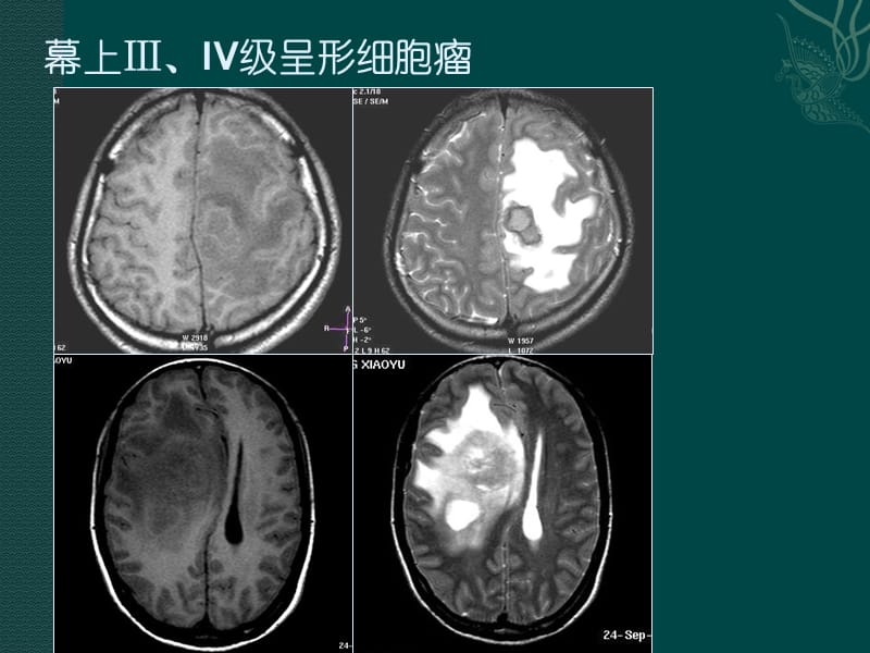 磁共振成但像读片题.ppt_第2页