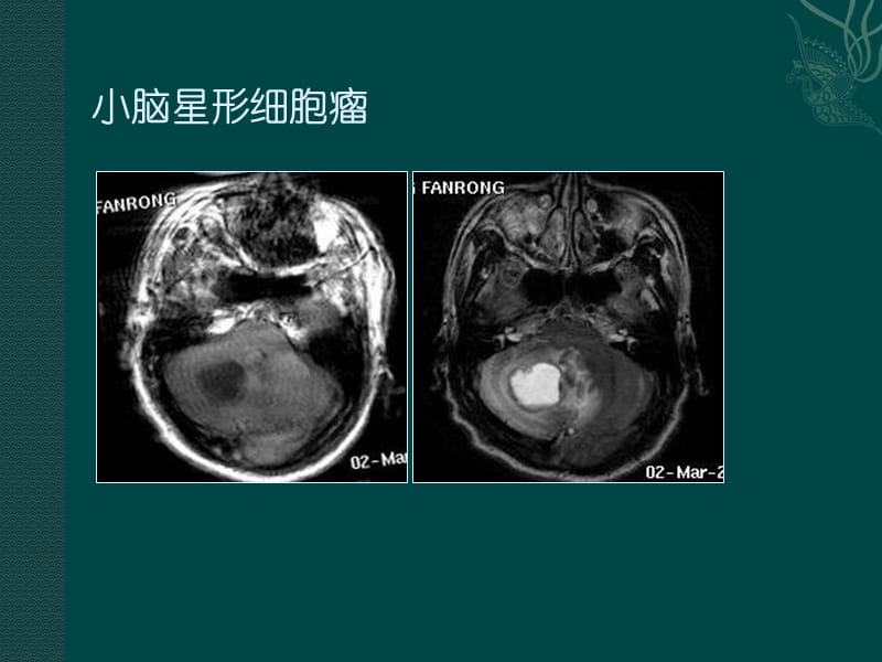 磁共振成但像读片题.ppt_第3页