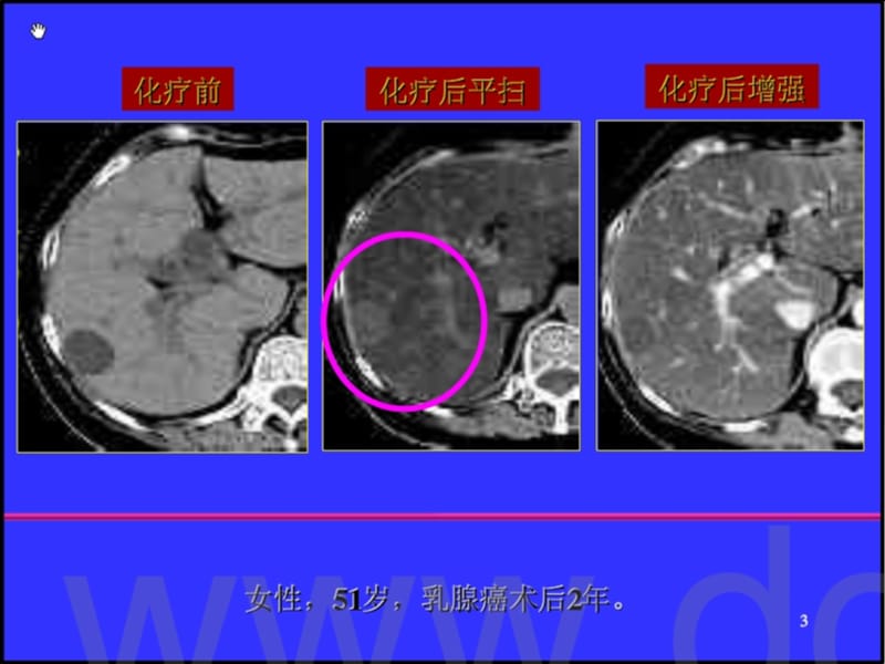 杨正汉-肝脏局灶病变诊断信息的获条取与分析ppt课件.ppt_第3页